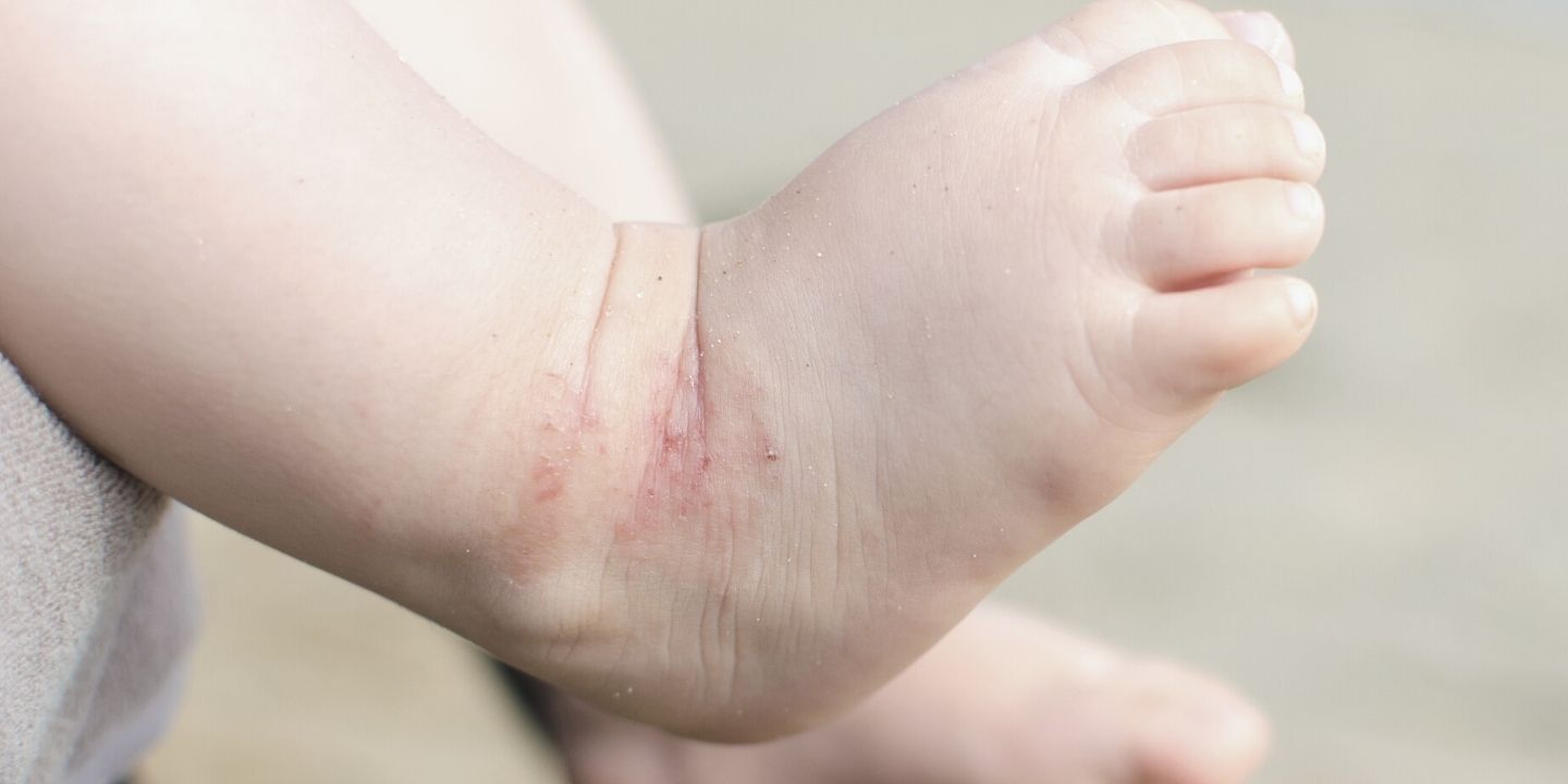 Is Bedding Causing An Allergic Reaction On Your Kids Skin °°º º°° DECORATOR_TITLE